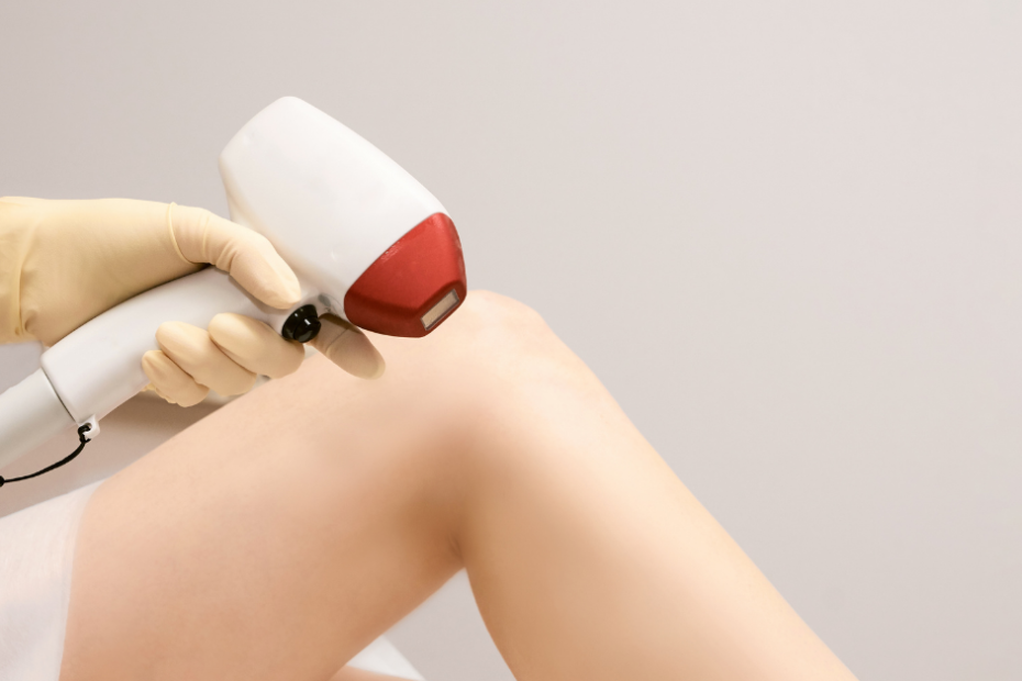 Laser hair removal treatment